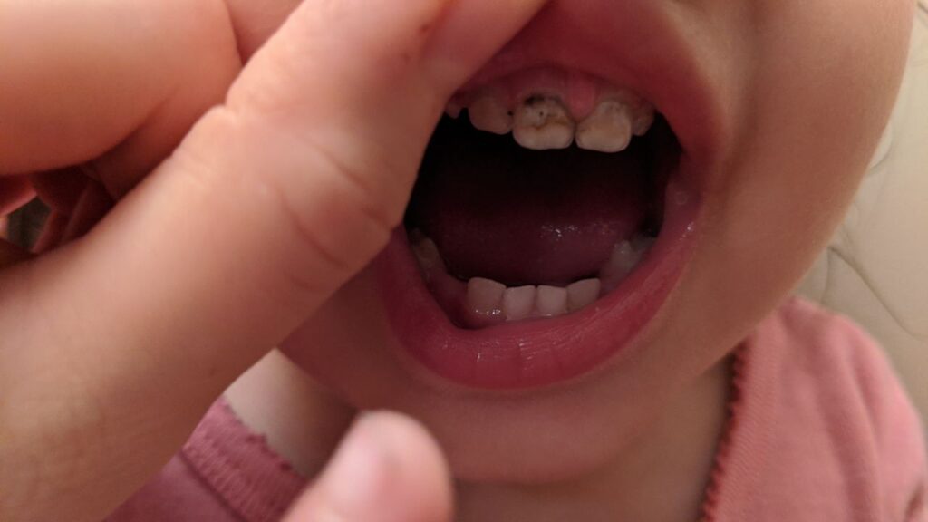 Mama Rissa's toddler with early childhood tooth decay on her teeth.