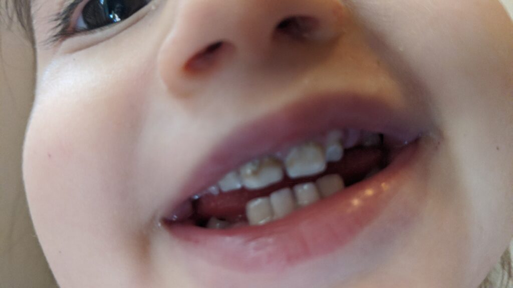 Mama Rissa's toddler's teeth exhibiting early childhood tooth decay.