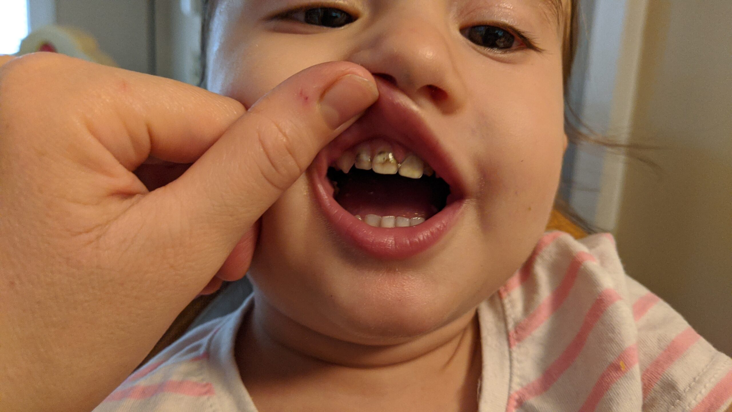 Mama Rissa's daughter showing her early childhood caries