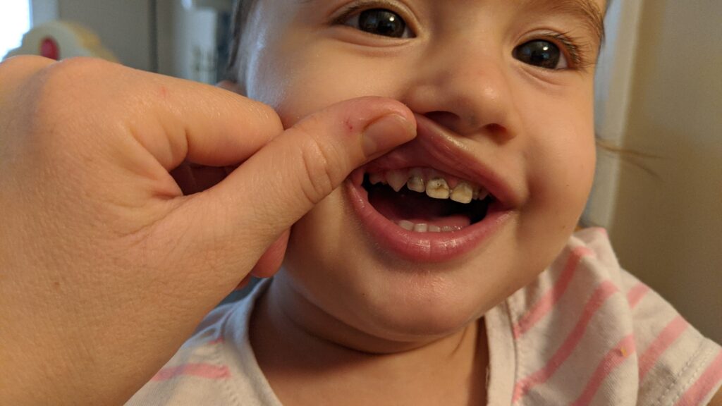 Early Childhood Caries Treatment