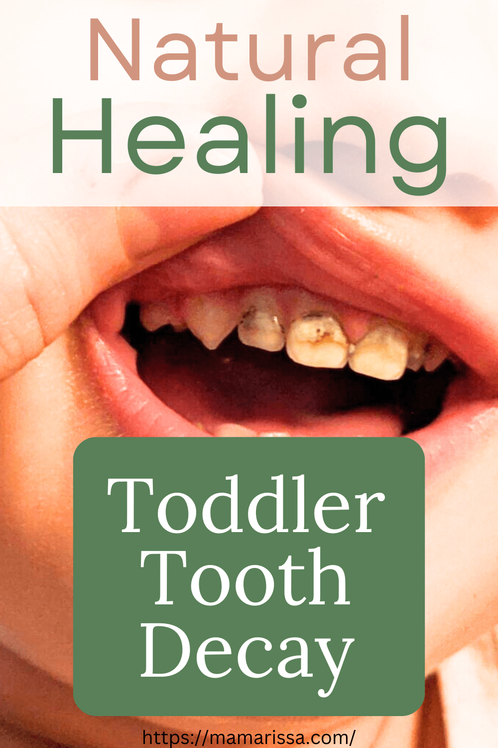 Natural Healing 
Toddler Tooth Decay