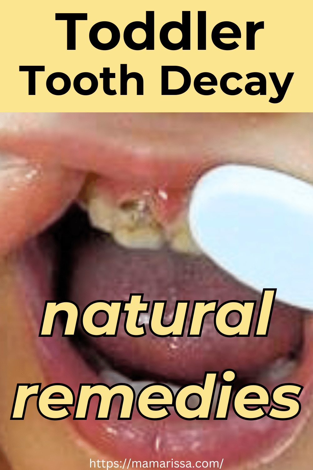 Toddler Tooth Decay Natural Remedies