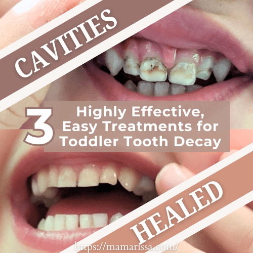 3 Highly Effective, Easy Treatments for Toddler Tooth Decay