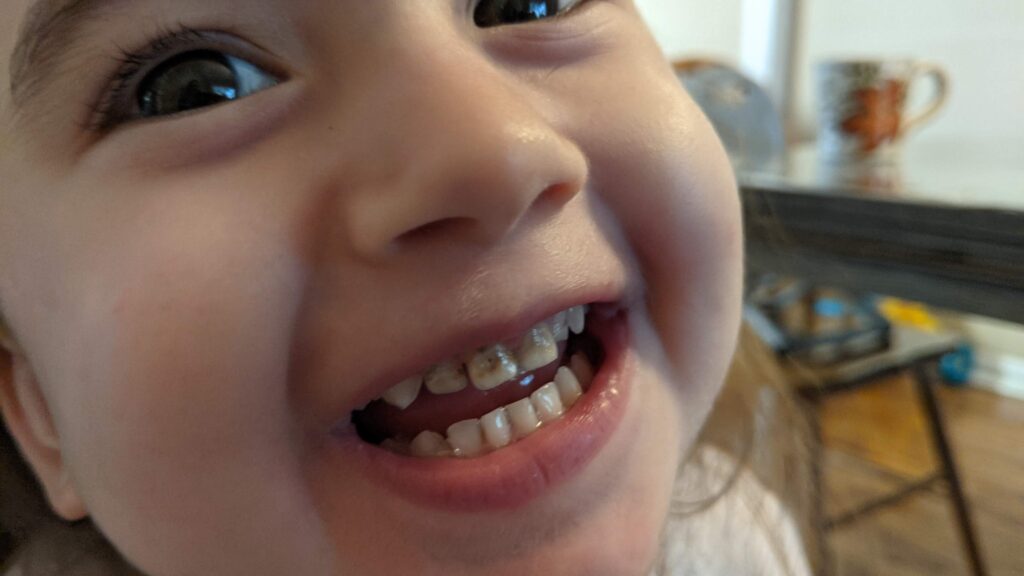 Daughter's stained teeth.
