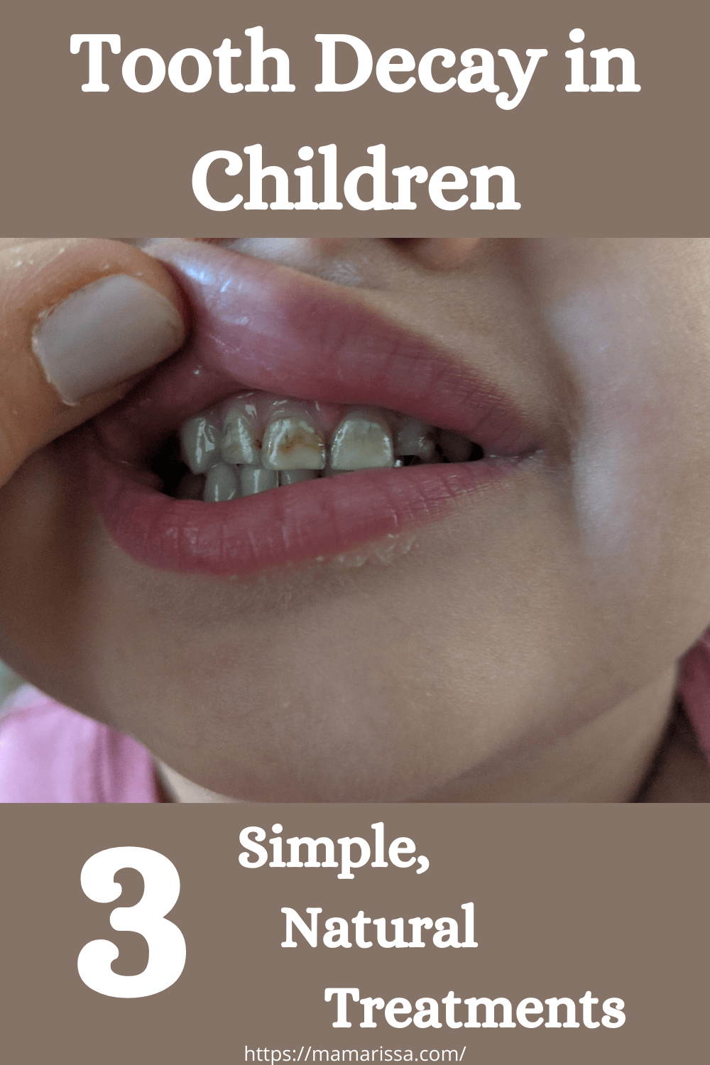 Tooth Decay in Children: 3 Simple, Natural Treatments