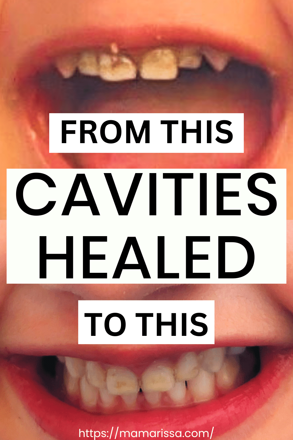 Cavities Healed