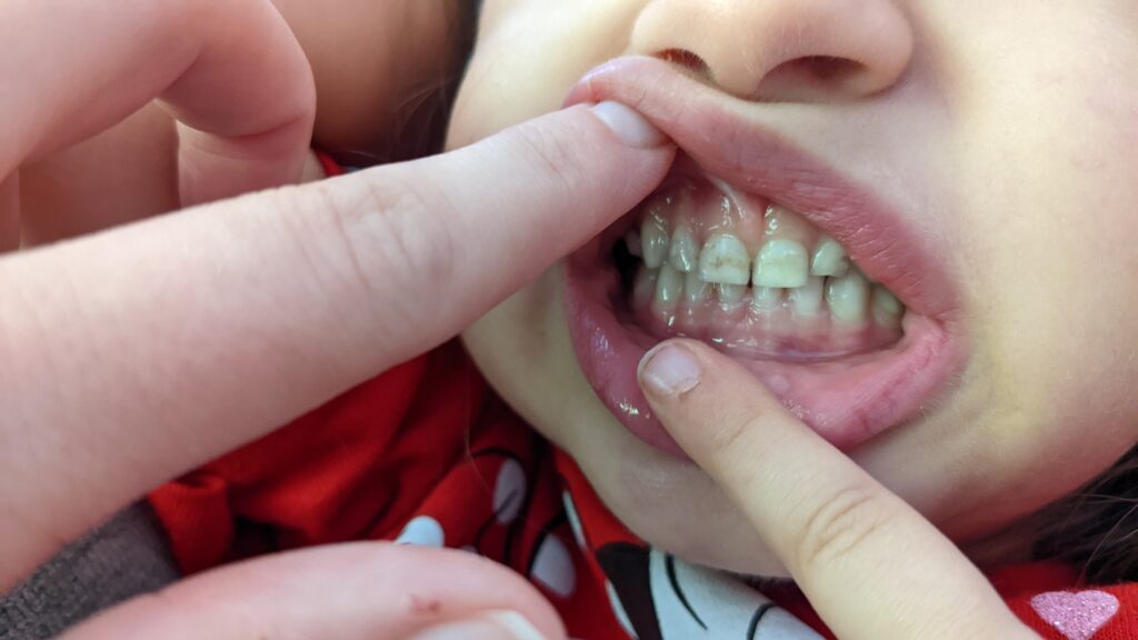 Daughter's teeth