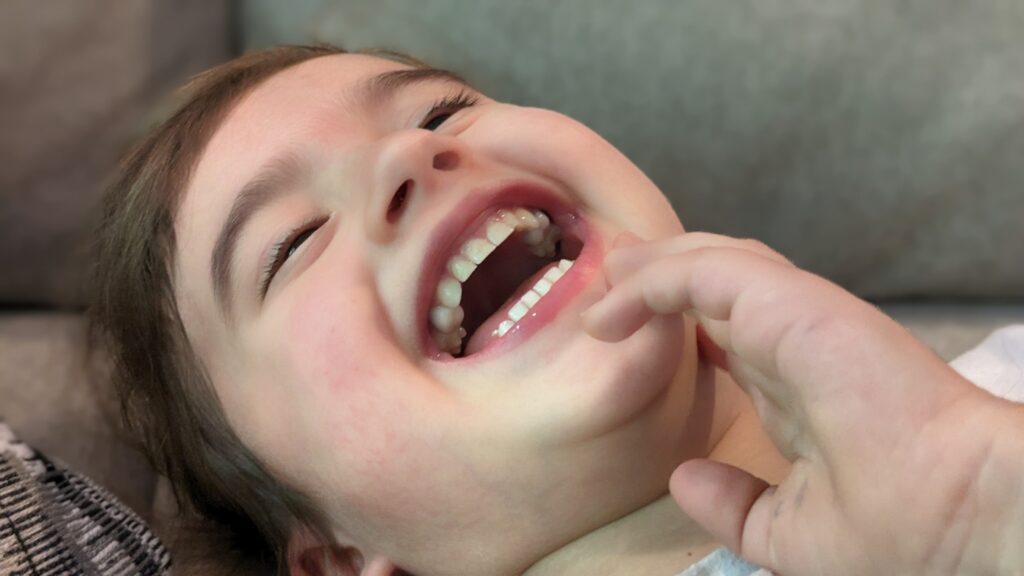 Daughter laughing, showing dental crowns.