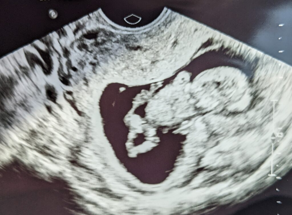 Mama Rissa`s ultrasound picture from her pregnancy after recurrent miscarriage