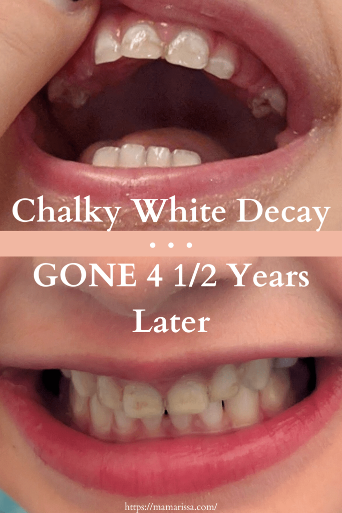 Chalky White decay GONE 4 1/2 years later