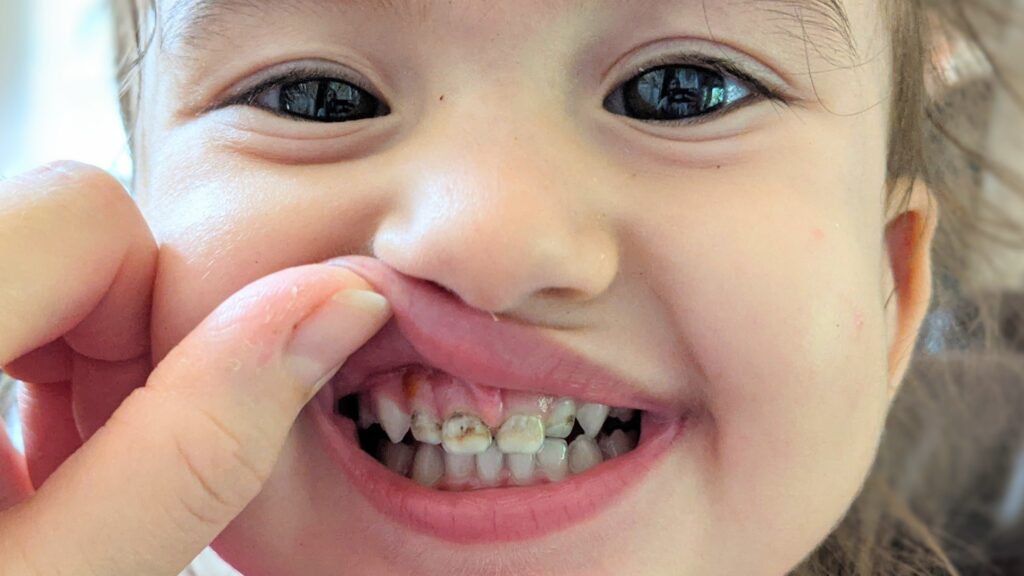 Image of Teeth Discoloration