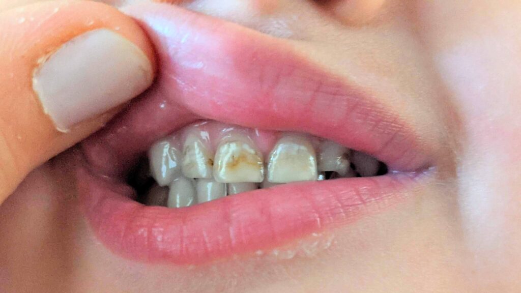 Image of Stains Partially Cleaned off of Teeth