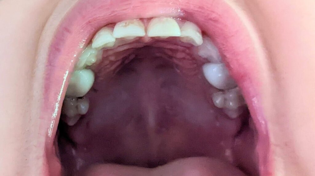 Image of crowns on child