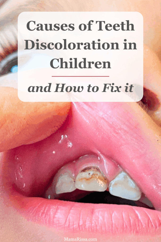 Teeth Discoloration in Children
