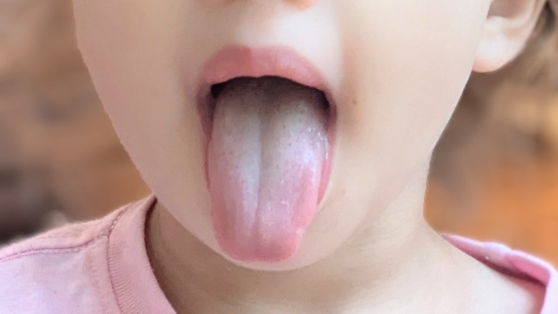 Image of tongue